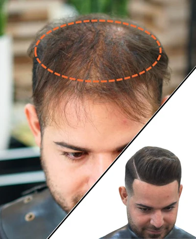 Thinning Hair and Baldness 4