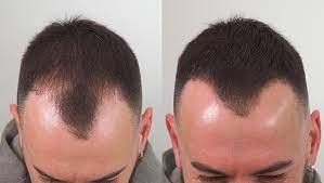 Thinning Hair and Baldness 5